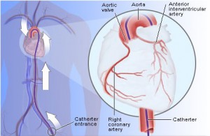Stricture urethra treatment in pune