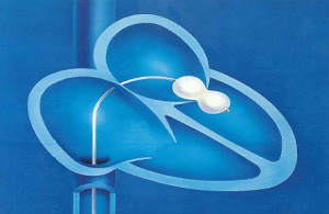 kidney stone treatment in pune