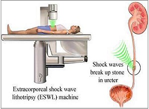 laser treatment for kidney stone in pune