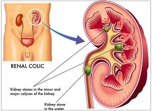 renal stone treatment in pune