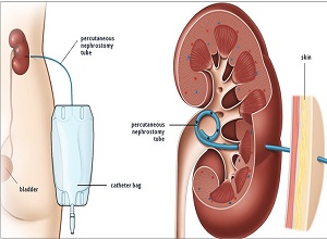 kideny doctor in pune