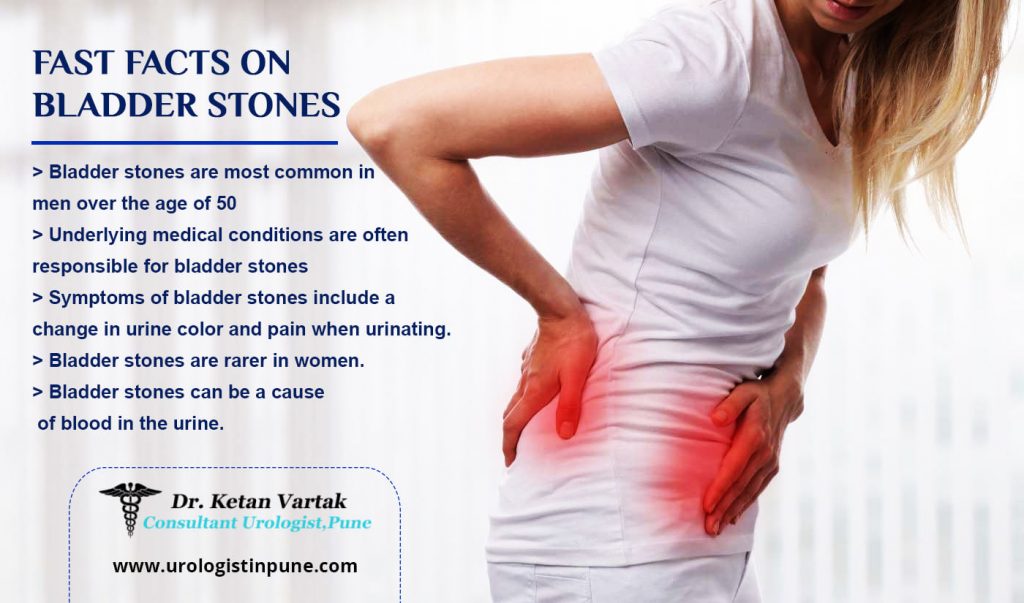 What is Bladder Stone and It's Symptoms? Dr. Ketan Vartak