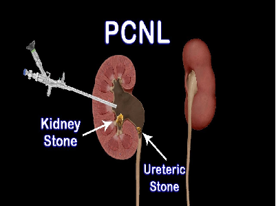 pcnl